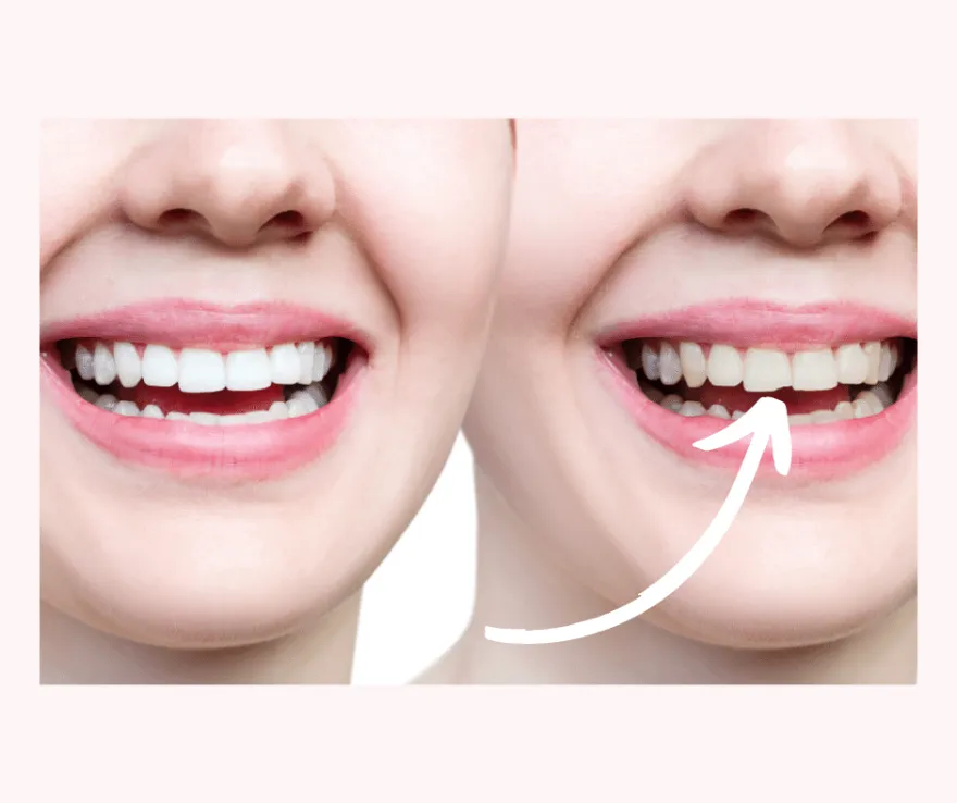 Before and after of a gapped smile, with an arrow marking the closed gap.