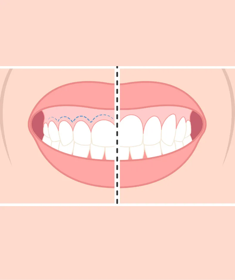 Illustration comparing a receded gum line with a corrected one.