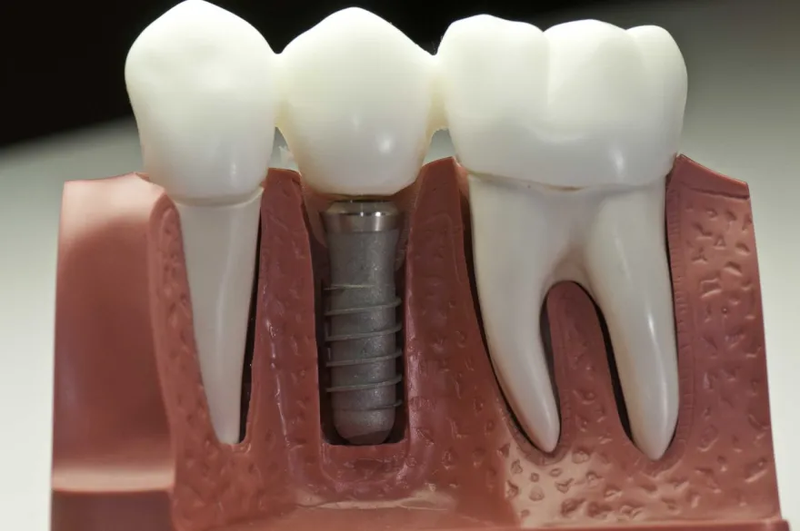 Model of a jaw showing a titanium implant post beside natural tooth roots.