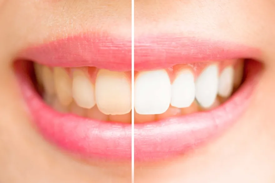 A smile split down the middle, stained on one side and whitened on the other.