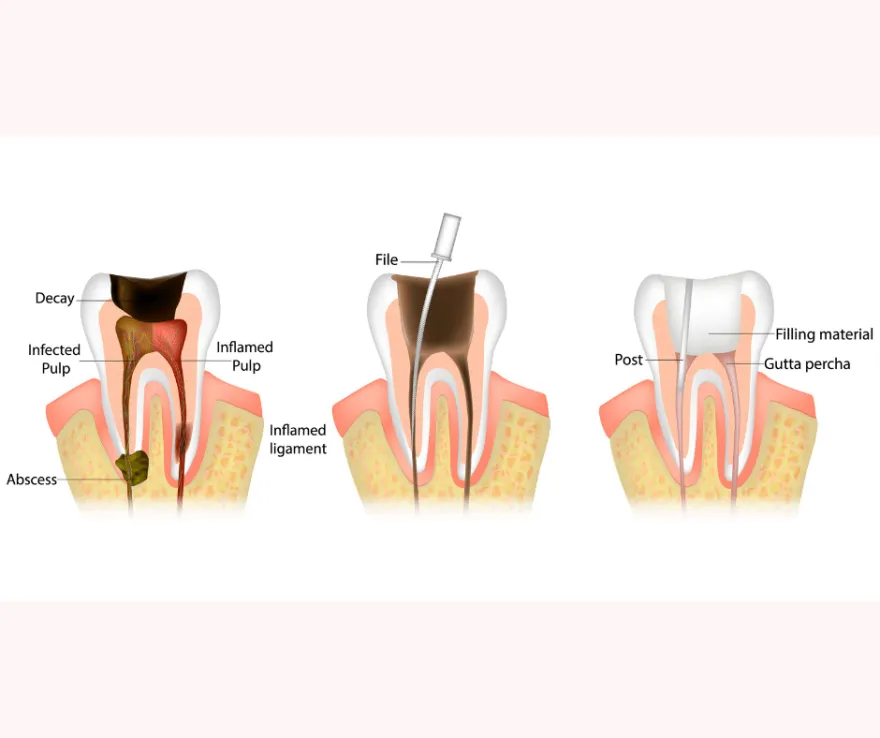Three-stage diagram of a root canal: infected pulp, the canal being cleaned with a file, and the sealed and filled tooth.