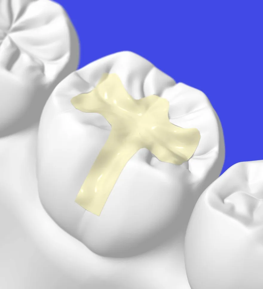 A close-up model of a molar with a gold-coloured filling seated in the prepared cavity.