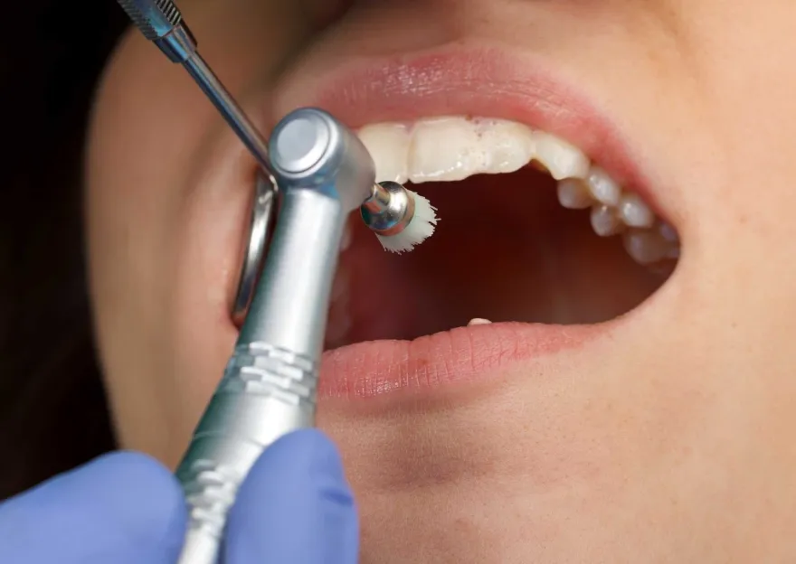 A dental handpiece polishing a patient's lower front teeth.