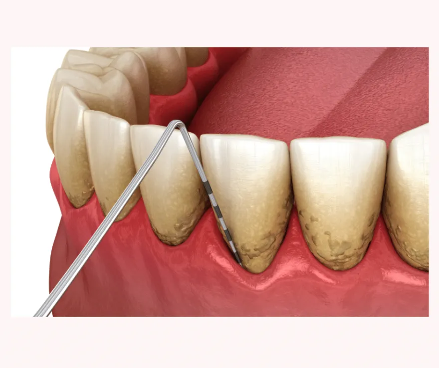Illustration of a scaler reaching below the gum line to remove tartar from between the teeth.