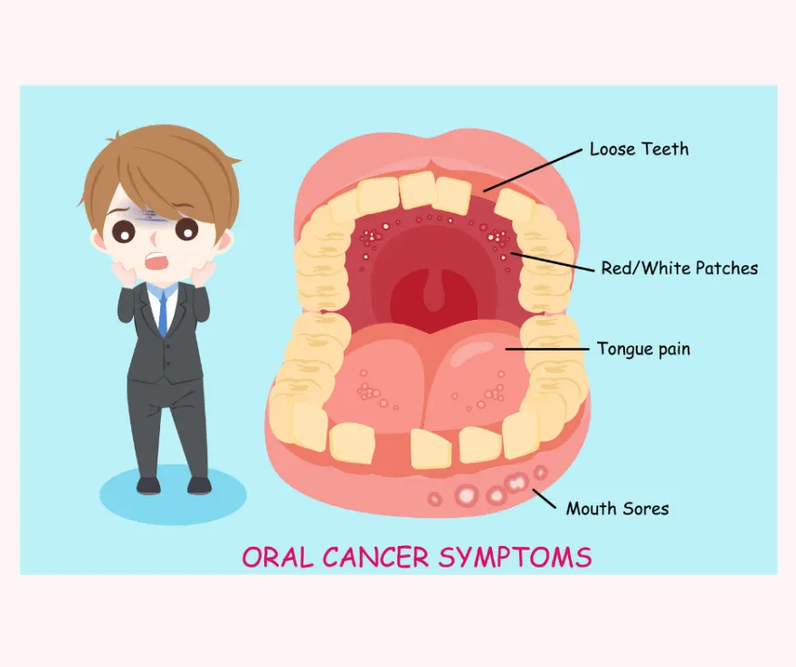 Infographic labelling the symptoms of oral cancer: loose teeth, red and white patches, tongue pain and mouth sores.