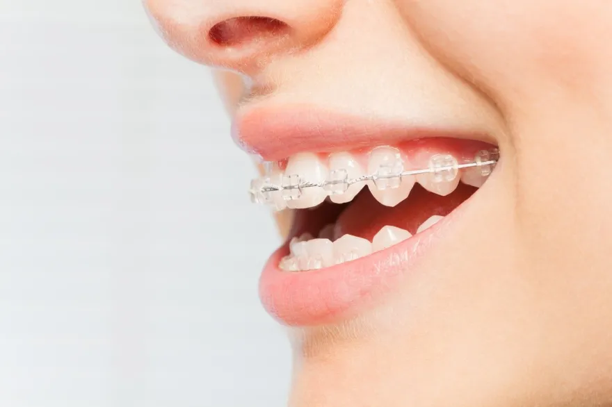 Profile view of a smile wearing fixed braces.
