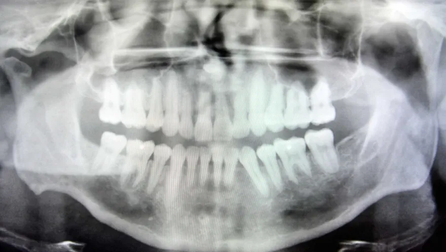 A panoramic dental X-ray showing the full upper and lower arches.