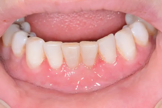 The same lower arch after a gum lift, the gum line restored over the roots.