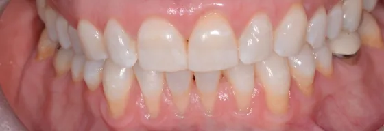 Close-up of a lower arch where the gums have receded, exposing the roots of the teeth.